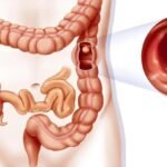 Intussusception