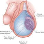 Pediatric Hydrocele