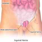 Hernia