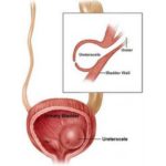 Ureterocele