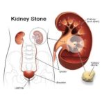 Kidney Stone