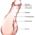 Hypospadias