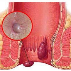 Piles, Fissure, Fistula
