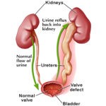 Vesico Ureteric Reflux